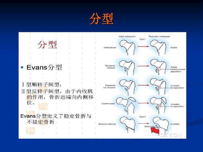 evans-evans分型